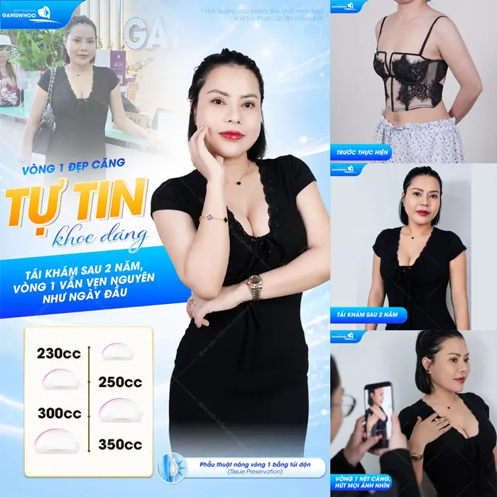 Vòng 1 đẹp căng tròn tự tin khoe dáng tái khám sau 2 năm vòng 1 vẫn đẹp nguyên vẹn như ngày đầu