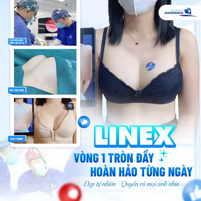 Nâng Ngực Line X – Vòng 1 Gợi Cảm Chuẩn Tỉ Lệ Vàng 5 Vòng 1 đẹp tròn đầy hoàn hảo từng ngày sau 1 tháng nâng vòng 1 Line X