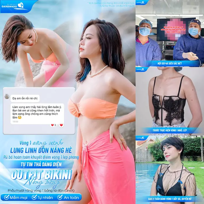Phẫu Thuật Nội Soi Nâng Ngực (Nâng Ngực Ergonomix) - Ngực Đẹp Mềm Mại Thêm Căng Tròn 15 vong 1 lung linh don nang he cuc chay sau phau thuat nang vong 1 bang tui don