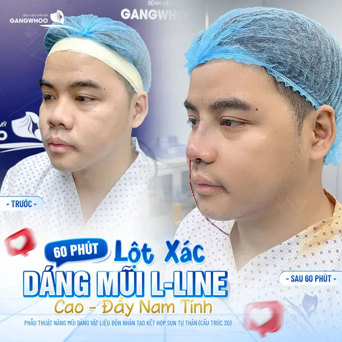 60 phút lột xác dáng mũi L Line cao, đẹp đầy nam tính diện mạo thăng hạng và phong độ hơn thấy rõ