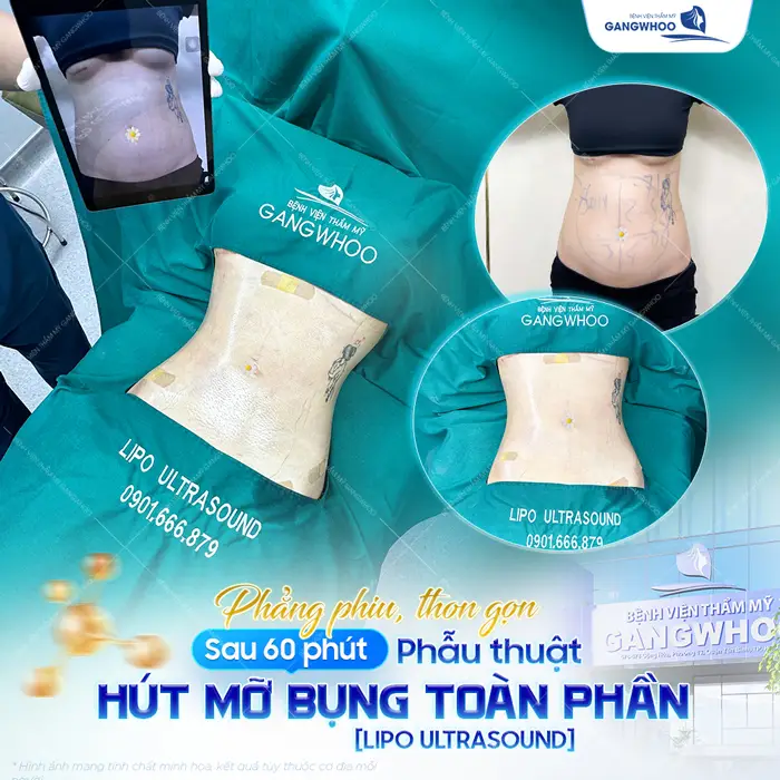 Hút mỡ trả góp có thật không? Giới thiệu địa chỉ hút mỡ trả góp uy tín