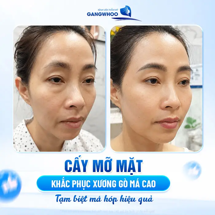 Bảng Giá Cấy Mỡ Mặt Mới - Tại Bệnh Viện Thẩm Mỹ Gangwhoo 1 Cấy mỡ mặt khắc phục xương gò má cao tạm biệt tình trạng má hóp hiệu quả