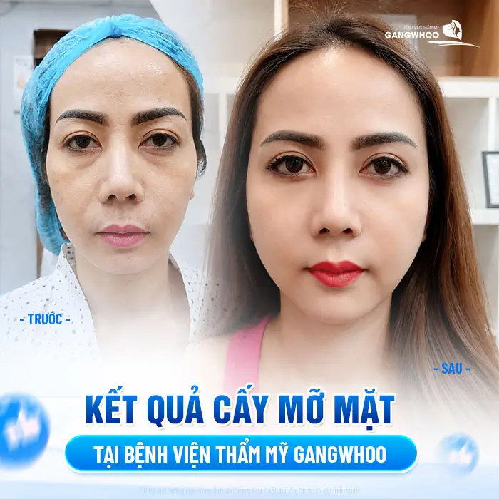 Bảng Giá Cấy Mỡ Mặt Mới - Tại Bệnh Viện Thẩm Mỹ Gangwhoo 2 Kết quả cấy mỡ mặt tại bệnh viện thẩm mỹ Gangwhoo gương mặt đẹp tròn đầy và hài hòa hơn thấy rõ
