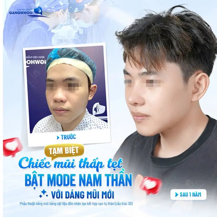 Tạm biệt chiếc mũi thấp tẹt bật mode nam thần với dáng mũi mới cao đẹp và hài hòa với gương mặt