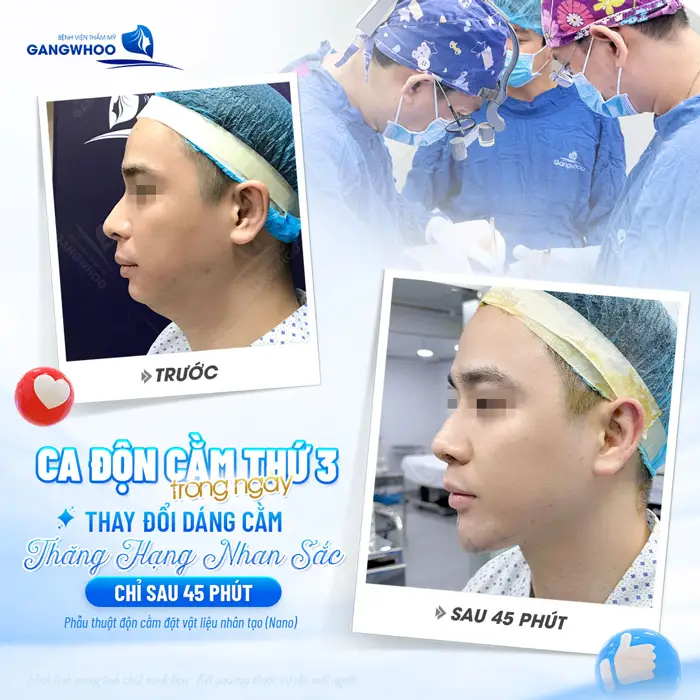 Thay đổi dáng cằm nhan sắc thăng hạng chỉ sau 45 phút thực hiện 