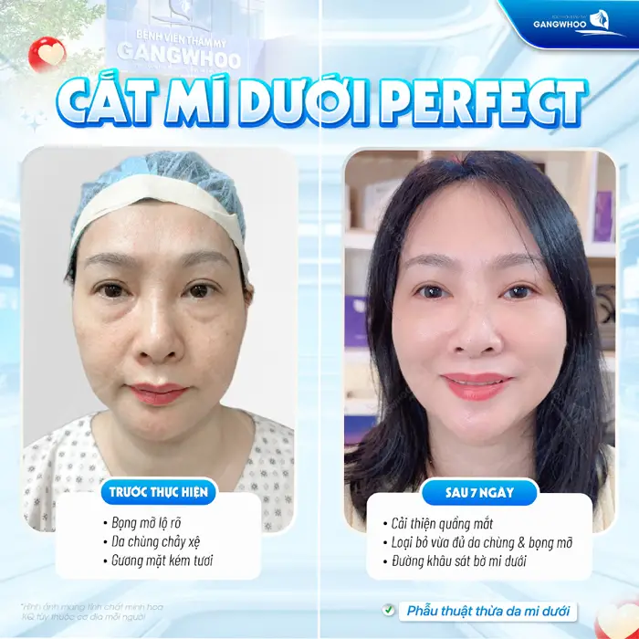 Cắt mí dưới Perfect sau 7 ngày can thiệp phẫu thuật cải thiện quầng mắt loại bỏ da chùng an toàn và hiệu quả 