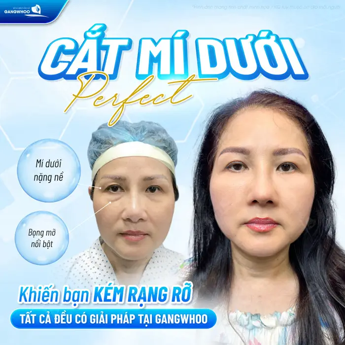 Cắt Mí Perfect Giải Pháp Cho Mắt 2 Mí Đẹp Hài Hòa Chuẩn Tự Nhiên 4 Cắt mí dưới Perfect khôi phục nét đẹp đầy rạng rỡ mí mắt không còn nặng nề