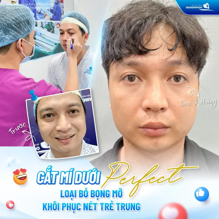 Cắt Mí Perfect Giải Pháp Cho Mắt 2 Mí Đẹp Hài Hòa Chuẩn Tự Nhiên 5 Cắt mí dưới Perfect loại bỏ bọng mỡ khôi phục nét đẹp trẻ trung sau phẫu thuật