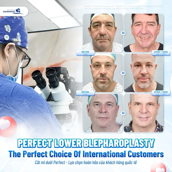 Cắt Mí Perfect Giải Pháp Cho Mắt 2 Mí Đẹp Hài Hòa Chuẩn Tự Nhiên 1 Cắt mí dưới Perfect lựa chọn hoàn hảo của khách hàng quốc tế