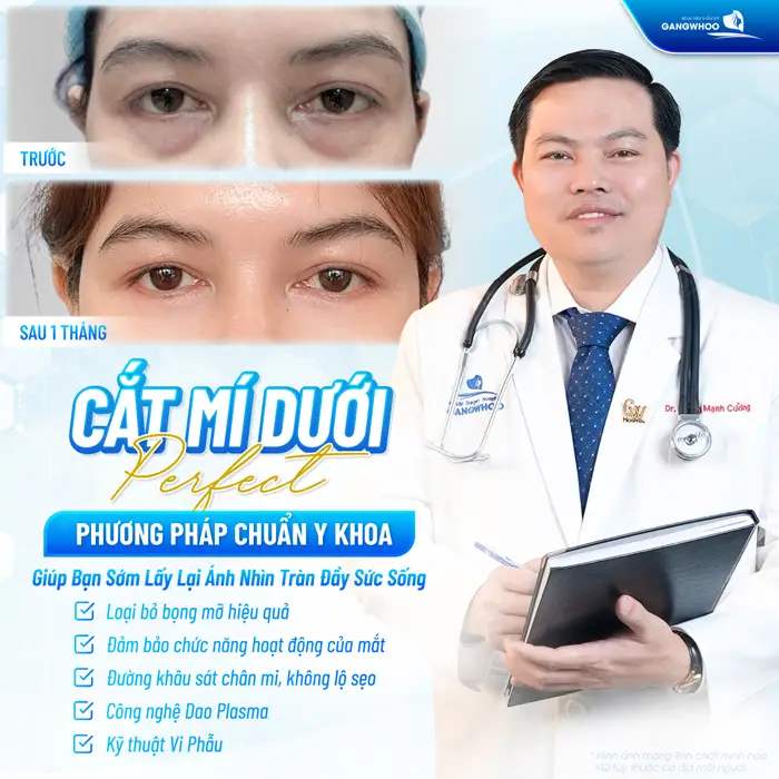 Cắt Mí Perfect Giải Pháp Cho Mắt 2 Mí Đẹp Hài Hòa Chuẩn Tự Nhiên 8 Cắt mí dưới Perfect phương pháp chuẩn y khoa giúp bạn sớm lấy lại diện mạo căng tràn sức sống