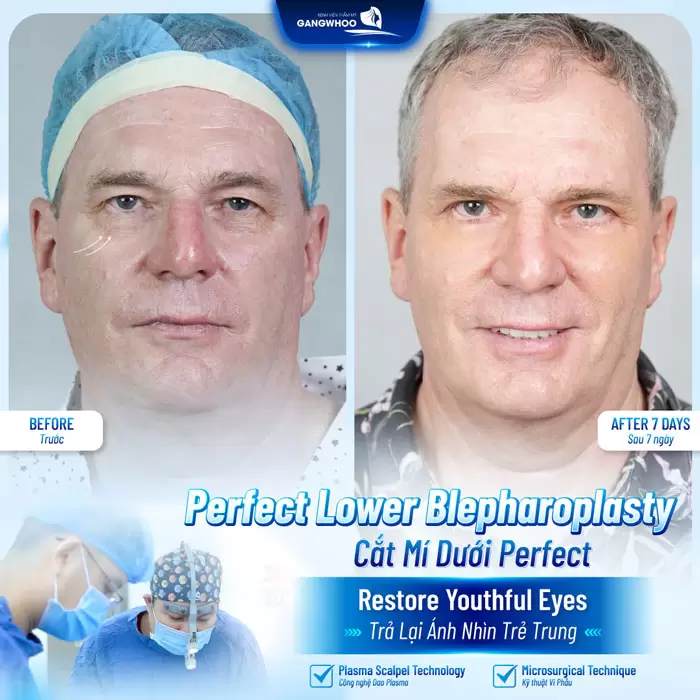 Cắt Mí Perfect Giải Pháp Cho Mắt 2 Mí Đẹp Hài Hòa Chuẩn Tự Nhiên 3 Cắt mí dưới Perfect tả lại ánh nhìn trẻ trung chỉ sau 7 ngày thực hiện