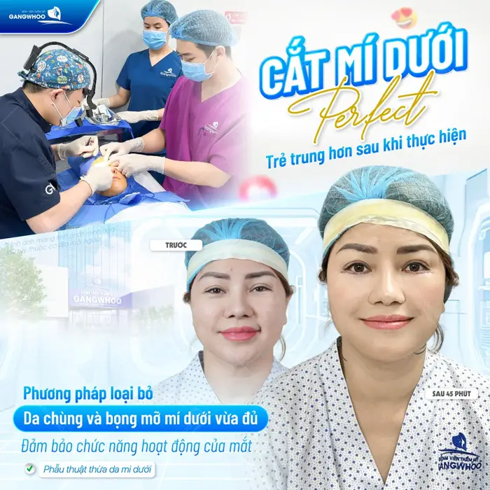Cắt mí dưới Perfect trẻ trung hơn sau khi thực hiện giúp loại bỏ da chùng và bọng mỡ mí dưới vừa đủ