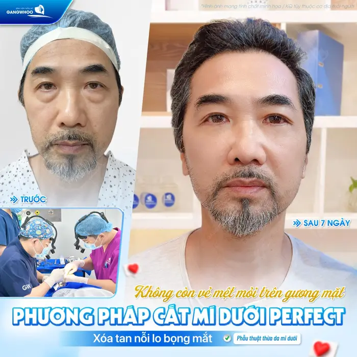 Không còn mệt mỏi trên gương mặt với phương pháp cắt mí dưới Perfect xóa tan nỗi lo bọng mắt 