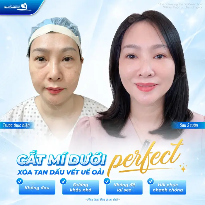 Cắt mí dưới Perfect xóa tan dấu vết uể oải không sưng đau, không để lại sẹo xấu sau phẫu thuật