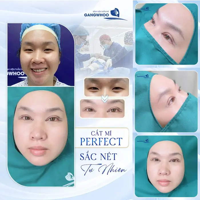 Cắt mí Eyelid bí quyết cho đôi mắt 2 mí đẹp tinh tế và hài hòa