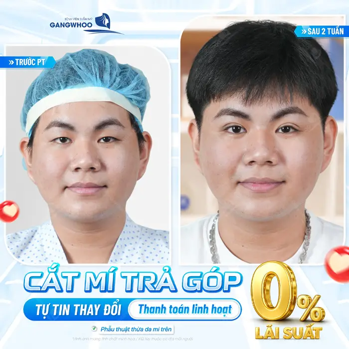 Cắt mí trả góp tự tin thay đổi bản thân với chi phí thanh toán linh hoạt không lo áp lực chi phí