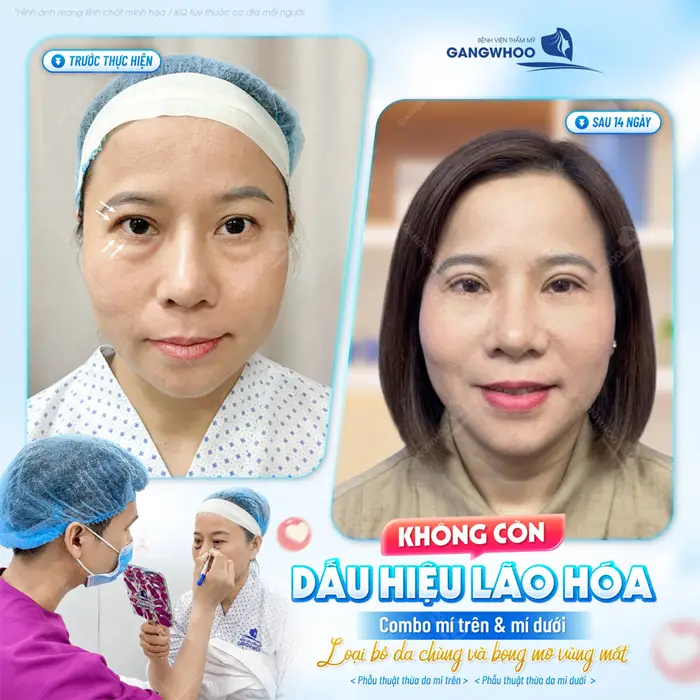 Trẻ hóa đôi mắt với combo cắt mí trên và mí dưới loại bỏ da chùng và bọng mỡ vùng mắt hiệu quả