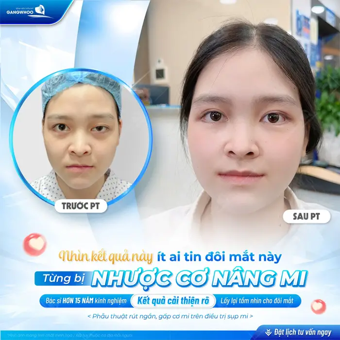 Từng bị nhược cơ nâng mi nhưng sau phẫu thuật với kết quả này ai cũng bất ngờ về màn lột xác 
