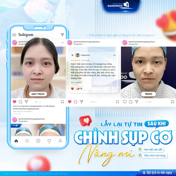 chinh sua nhuoc co nang mi khac phuc khuyet diem mat an toan va hieu qua
