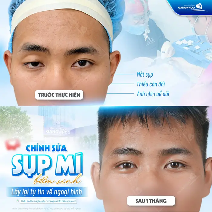 Phẫu Thuật Rút Ngắn, Gấp Cơ Nâng Mi Trên Điều Trị Sụp Mí Bẩm Sinh 10 Chỉnh sửa sụp mí bẩm sinh lấy lại diện mạo tự tin về ngoại hình sau 1 tháng ánh nhìn đã khác biệt
