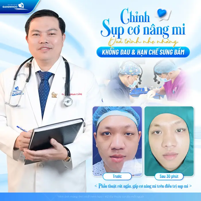 Phẫu thuật rút ngắn, gấp cơ nâng mi trên điều trị sụp mí hạn chế đau và sưng bầm hiệu quả