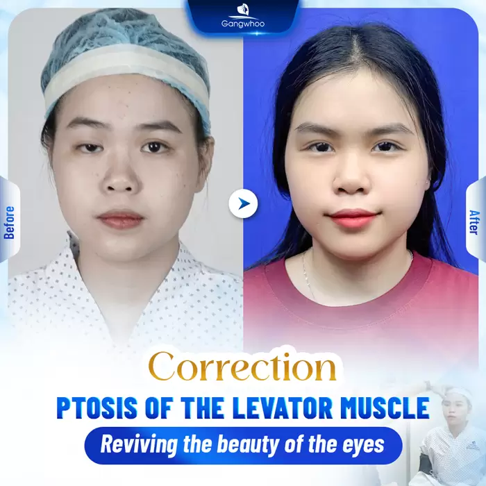 chinh sup mi bam sinh en 1