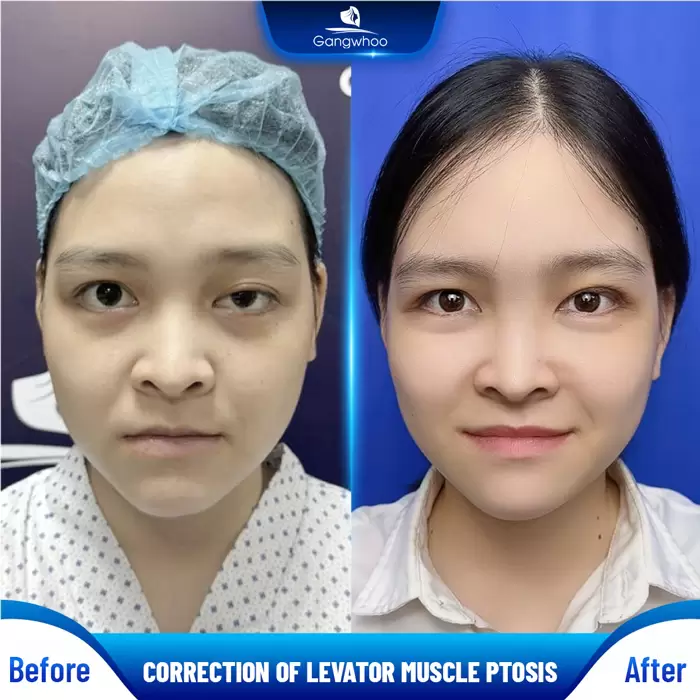 chinh sup mi bam sinh en 4