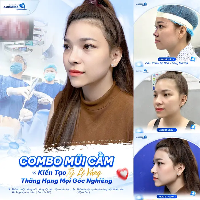 Nâng mũi kết hợp độn cằm kiến tạo tỷ lệ vàng thăng hạng mọi góc nghiêng 