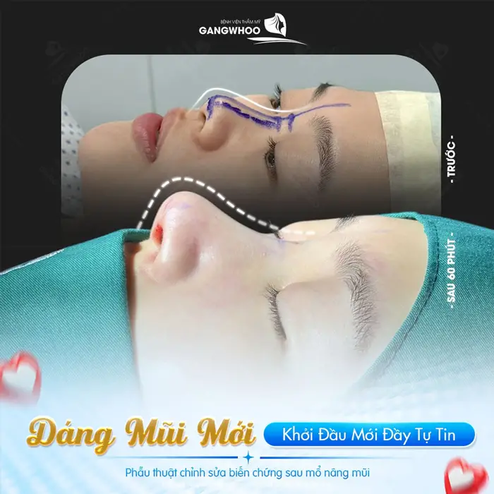 Dáng mũi mới khởi đầu mới đầy tự tin kết quả sau 60 phút phẫu thuật "màn lột xác" thay đổi đầy ngoạn mục