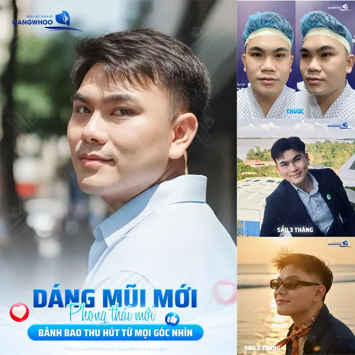 Dáng mũi mới phong thái mới diện mạo bảnh bao thu hút mọi góc nhìn sau phẫu thuật tạo hình mũi