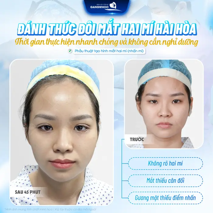 Đánh thức đôi mắt 2 mí hài hòa thời gian thực hiện nhanh chóng, an toàn và hiệu quả dài lâu