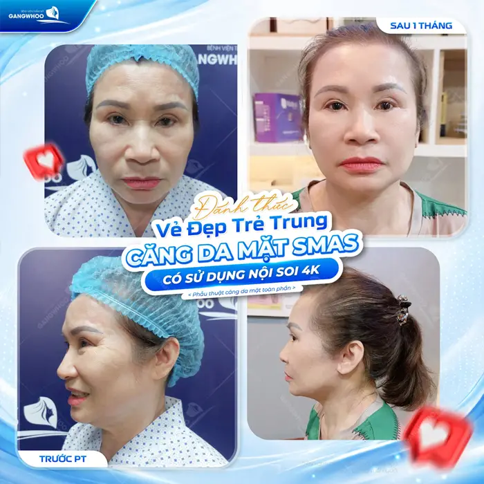 Đánh thức vẻ đẹp trẻ trung sau căng da mặt Smas tại bệnh viện thẩm mỹ Gangwhoo 