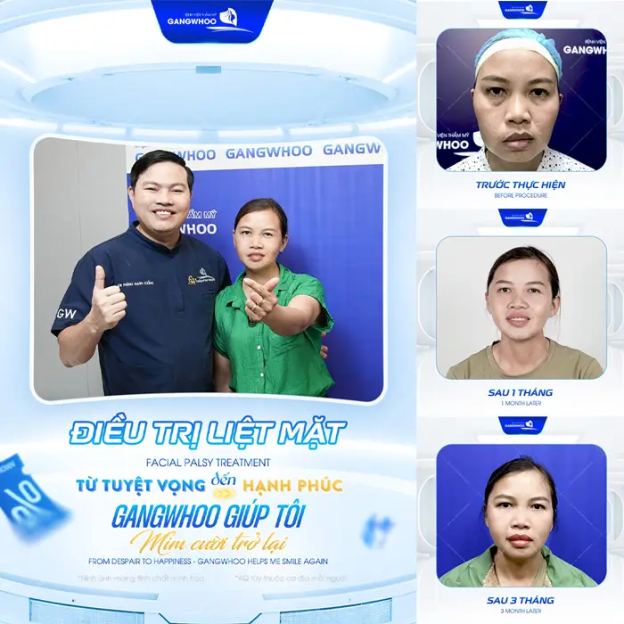 Điều trị liệt mặt mm cười hạnh phúc vì diện mạo mới cân đối hơn, hài hòa hơn