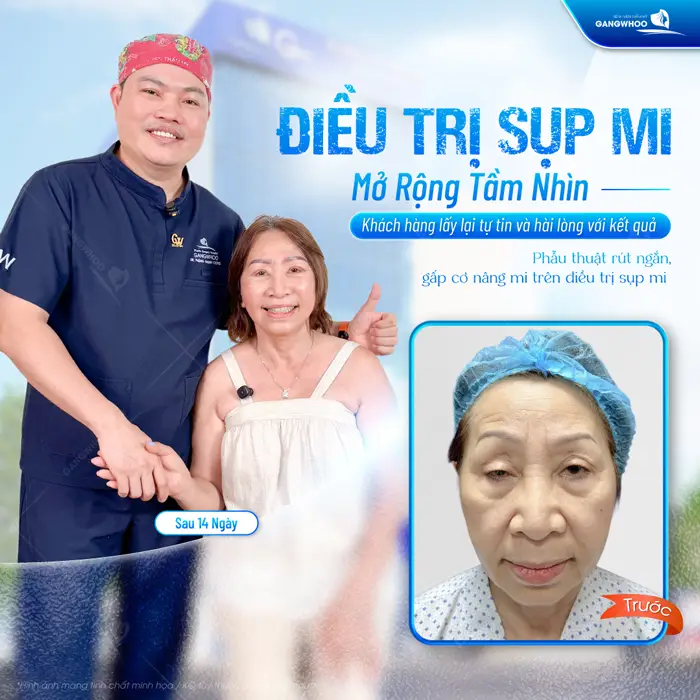 Phẫu thuật rút ngắn gấp cơ nâng mi trên điều trị sụp mi mở rộng tầm nhín cho ánh mắt