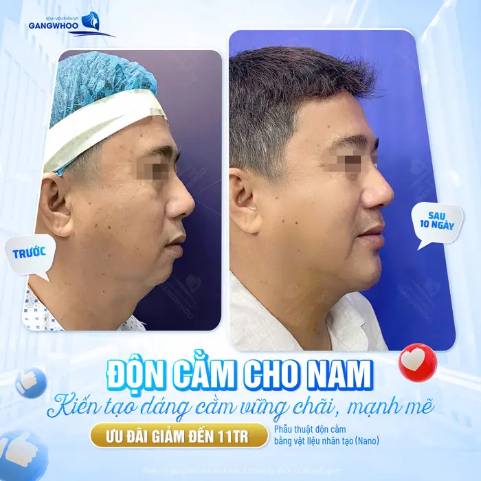 Độn cằm nam kiến tạo dáng cằm vững chãi, mạnh mẽ nét đẹp thêm hài hòa và ấn tượng