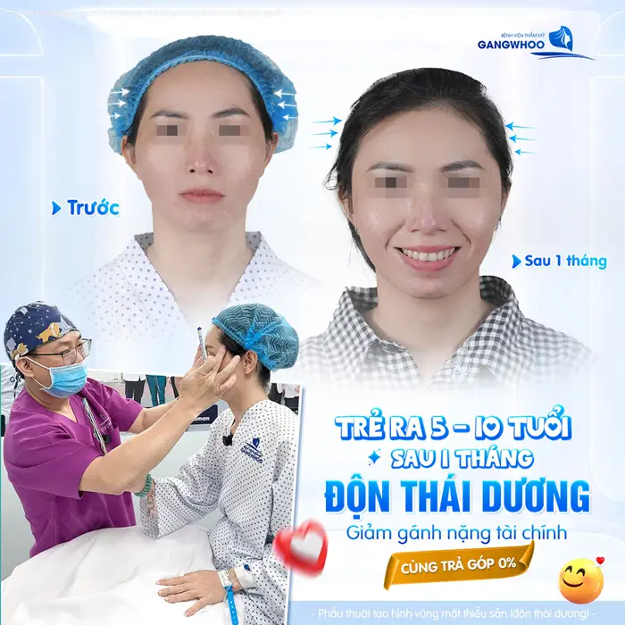Độn Thái Dương Trả Góp Nên Hay Không? Địa Chỉ Nào Uy Tín? 2 Sau 1 tháng độn thái dương gương mặt căng đẹp trẻ hơn trả góp 0% lãi suất không lo ghánh nặng chi phí