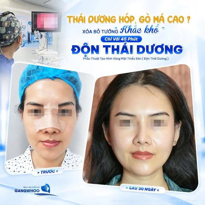 Kết quả sau 45 phút độn thái dương, thái dương hết hóp cải thiện đường nét gương mặt