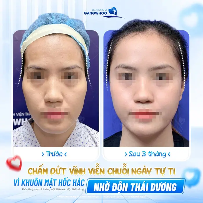 Tạm biệt khuôn mặt hốc hác sau 3 tháng độn thái dương gương mặt đã trở nên hài hòa và xuất sắc hơn hẳn