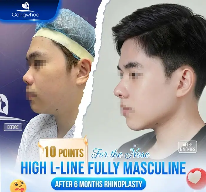 en gia nang mui khong phau thuat 1