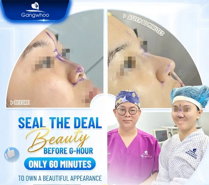 en nang mui khi nang mui khong phau thuat 2