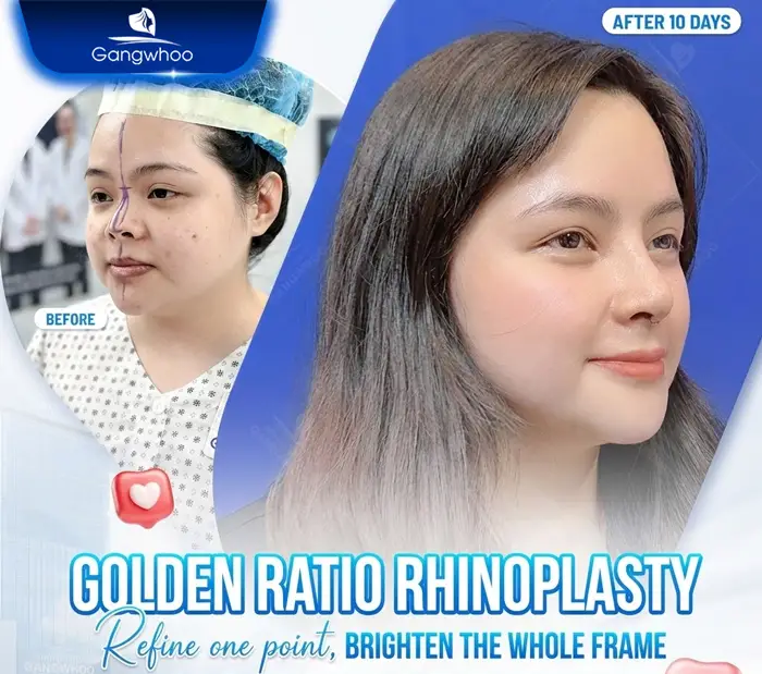 en nang mui khi nang mui khong phau thuat 3