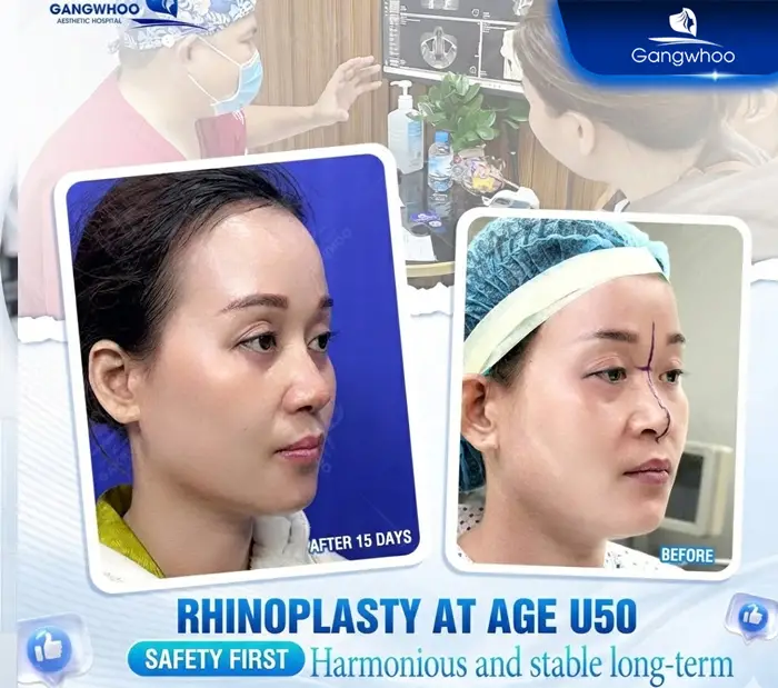 en nang mui khi nang mui khong phau thuat 4