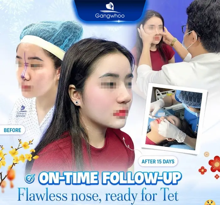 en nang mui khi nang mui khong phau thuat 6