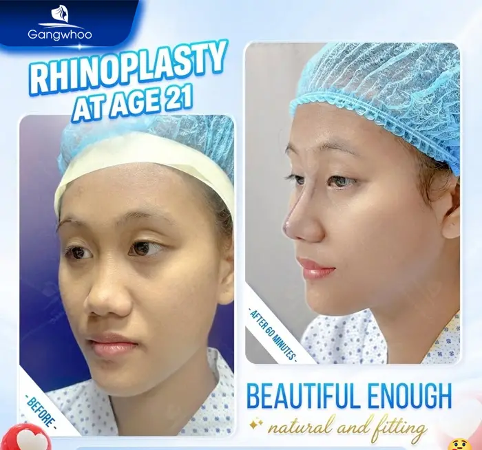 en nang mui khi nang mui khong phau thuat 7