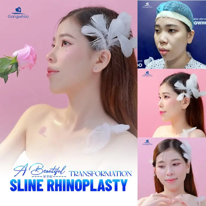 en nang mui khong phau thuat 1