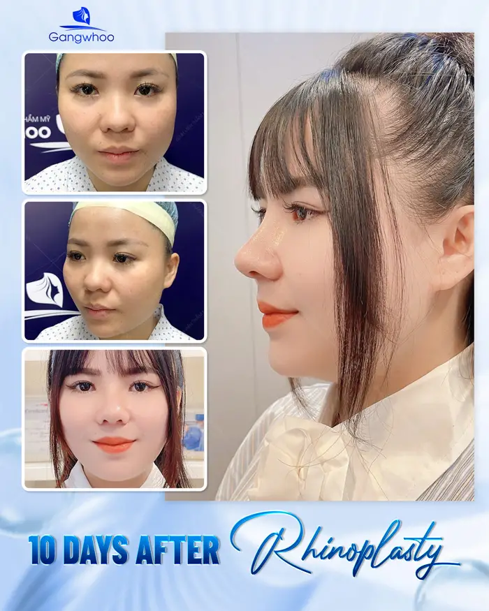 en nang mui khong phau thuat 2