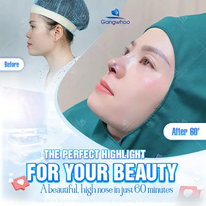 en nang mui khong phau thuat 3