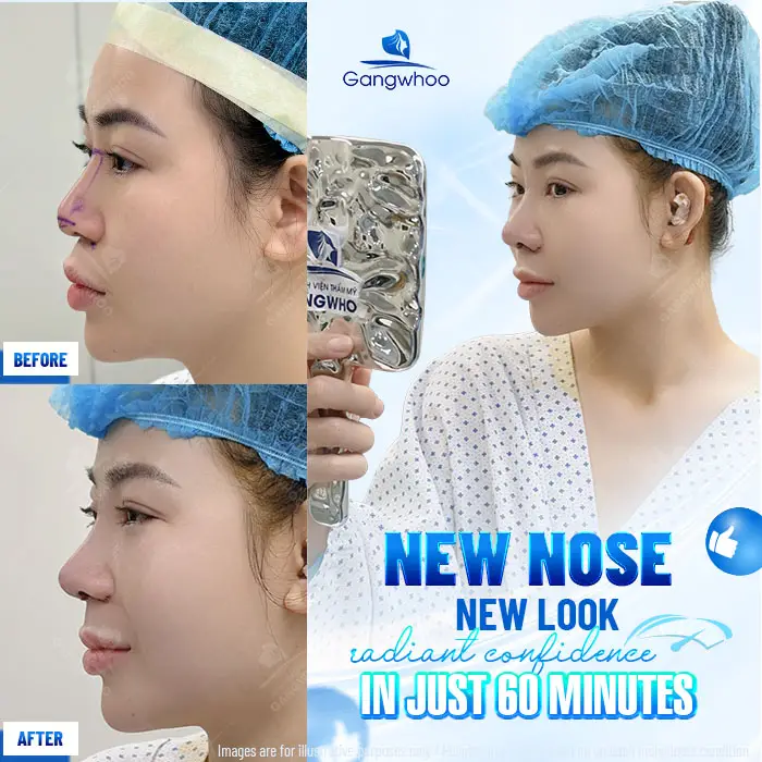 en nang mui khong phau thuat 4