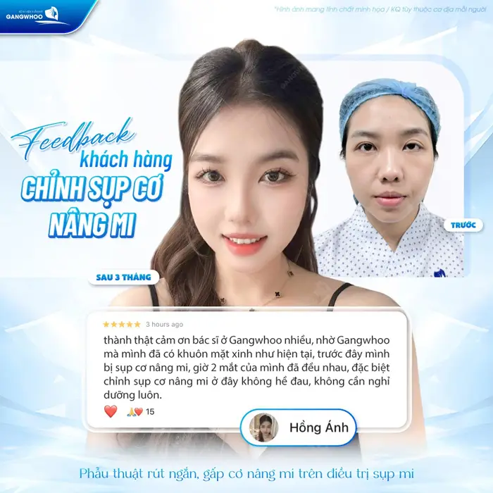 fb khach hang chinh sup co nang mi phan hoi sau can thiep phau thuat