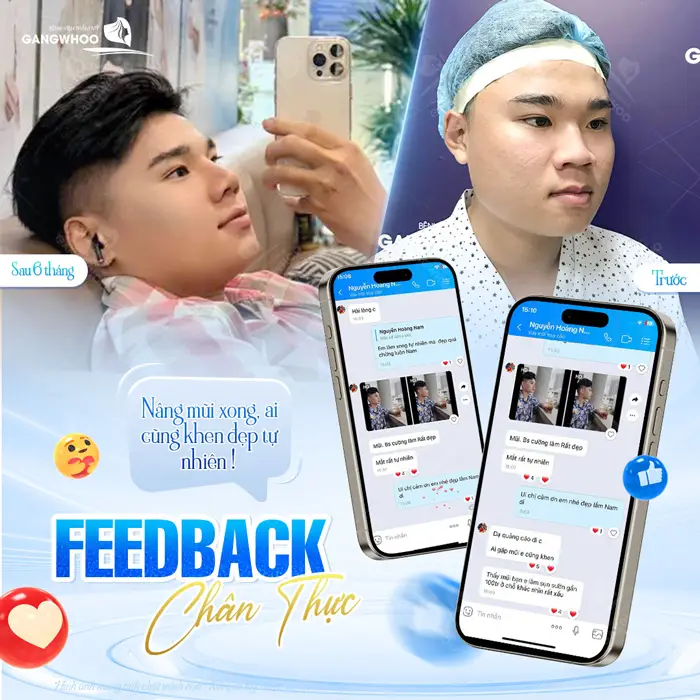 Feeback chân thực của bạn khách trẻ sau nâng mũi vì quá hài lòng với diện mạo mới